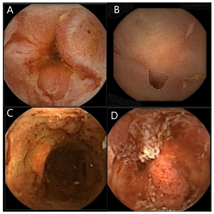 Bowel endoscopic images